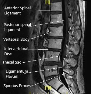 MRI of LS spine in sagittal and axial sections MRI of LS spine in sagittal and axial sections