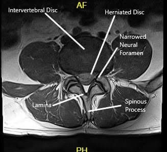 MRI of LS spine in sagittal and axial sections 2 MRI of LS spine in sagittal and axial sections 2