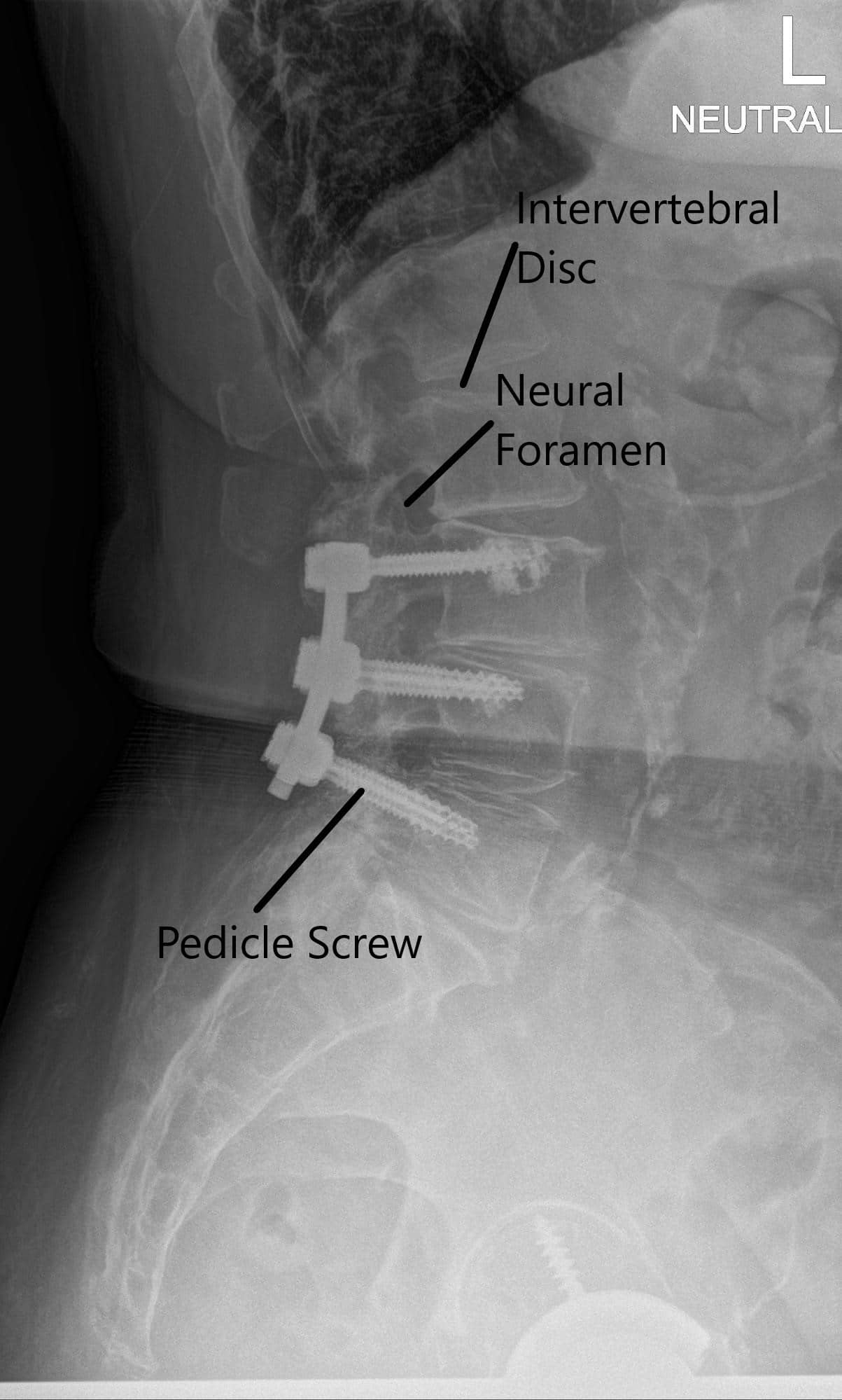 Radiografía de la columna vertebral del LS en vistas AP y laterales 2