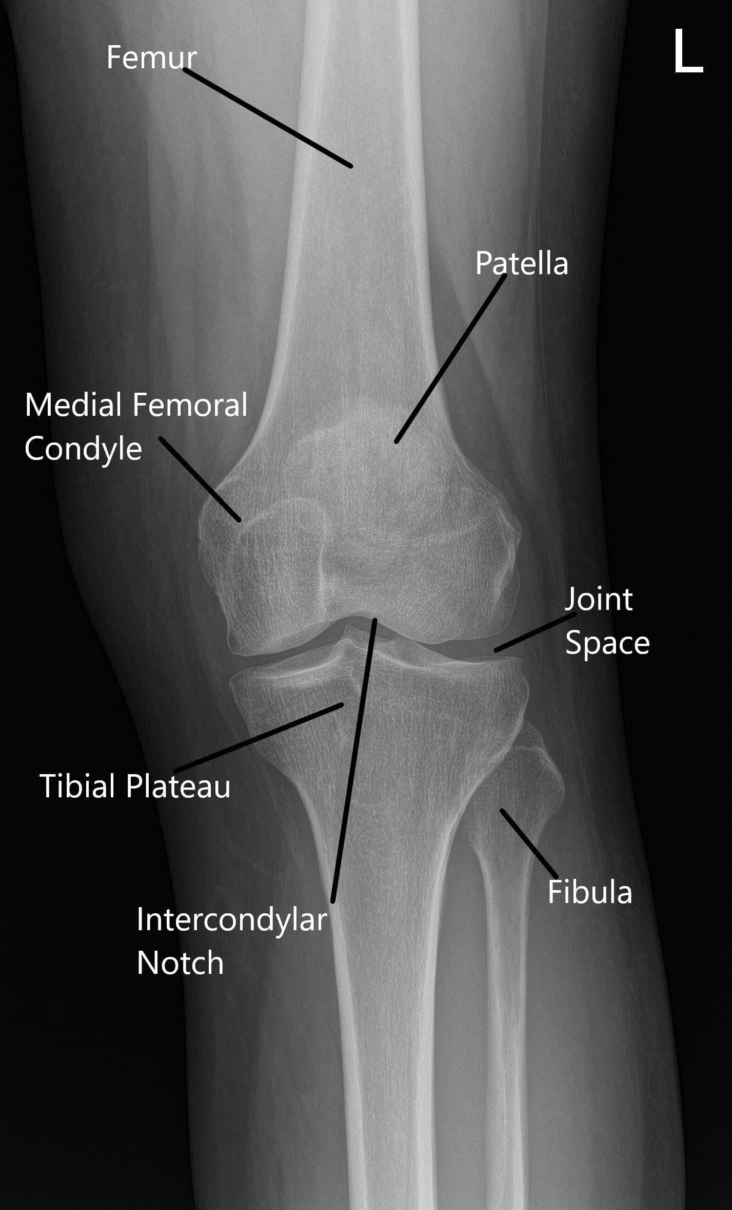 Normal X-ray of the knee joint showing the various structures in the Anteroposterior and Lateral view Normal X-ray of the knee joint showing the various structures in the Anteroposterior and Lateral view