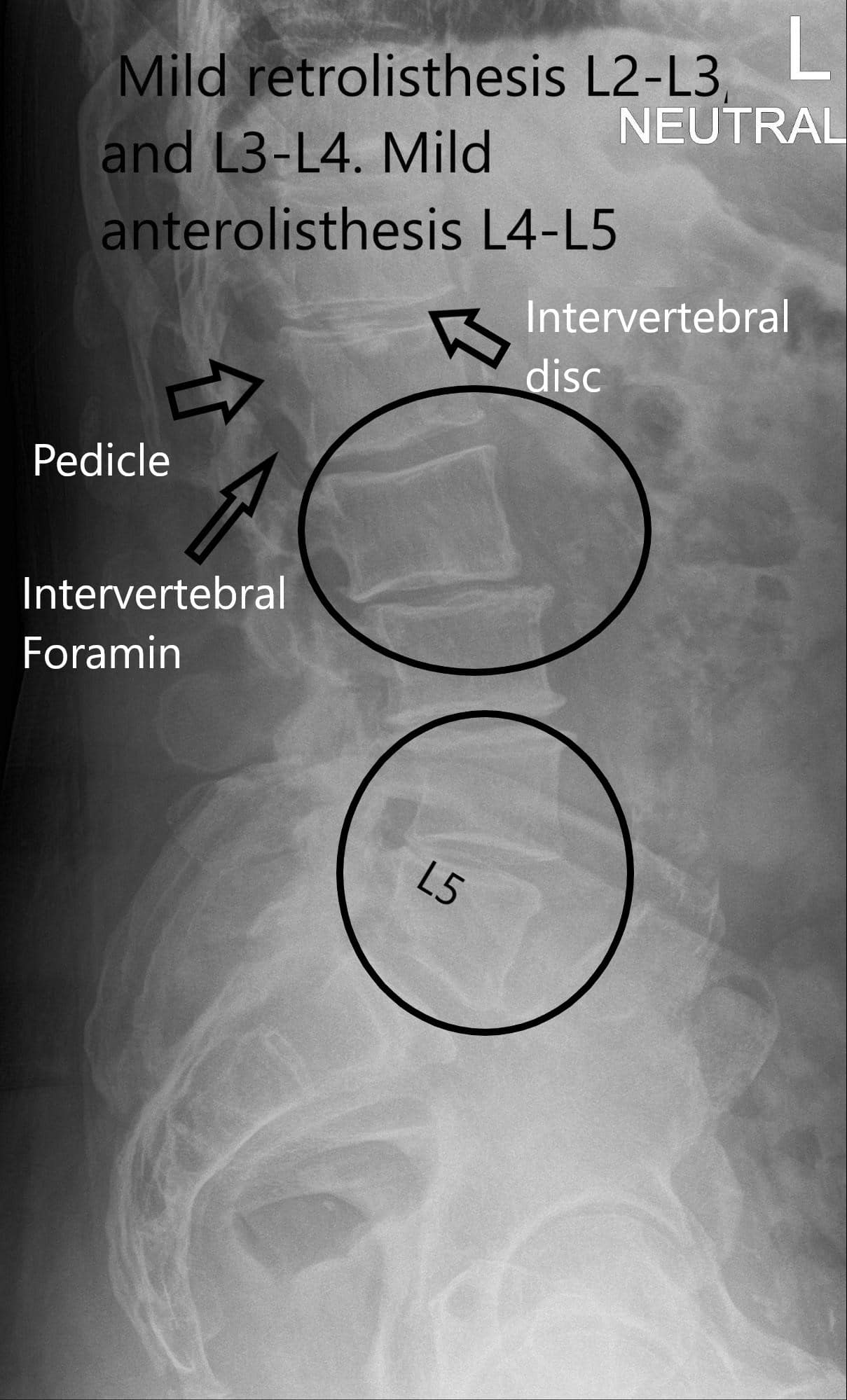 X-ray Lateral view of LS spine X-ray Lateral view of LS spine
