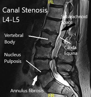 MRI of the lumbar spine MRI of the lumbar spine