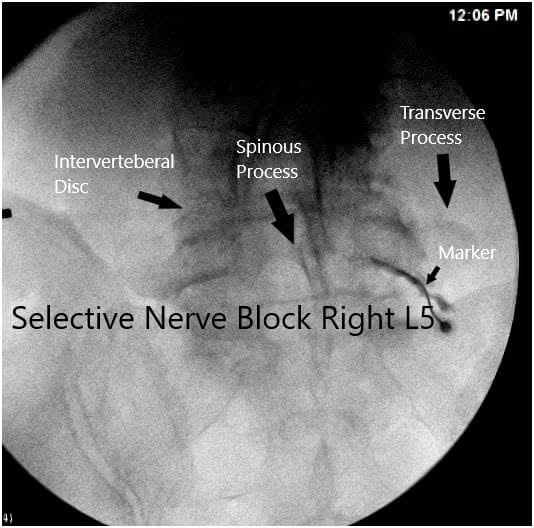 Intraoperative fluoroscopic image Intraoperative fluoroscopic image