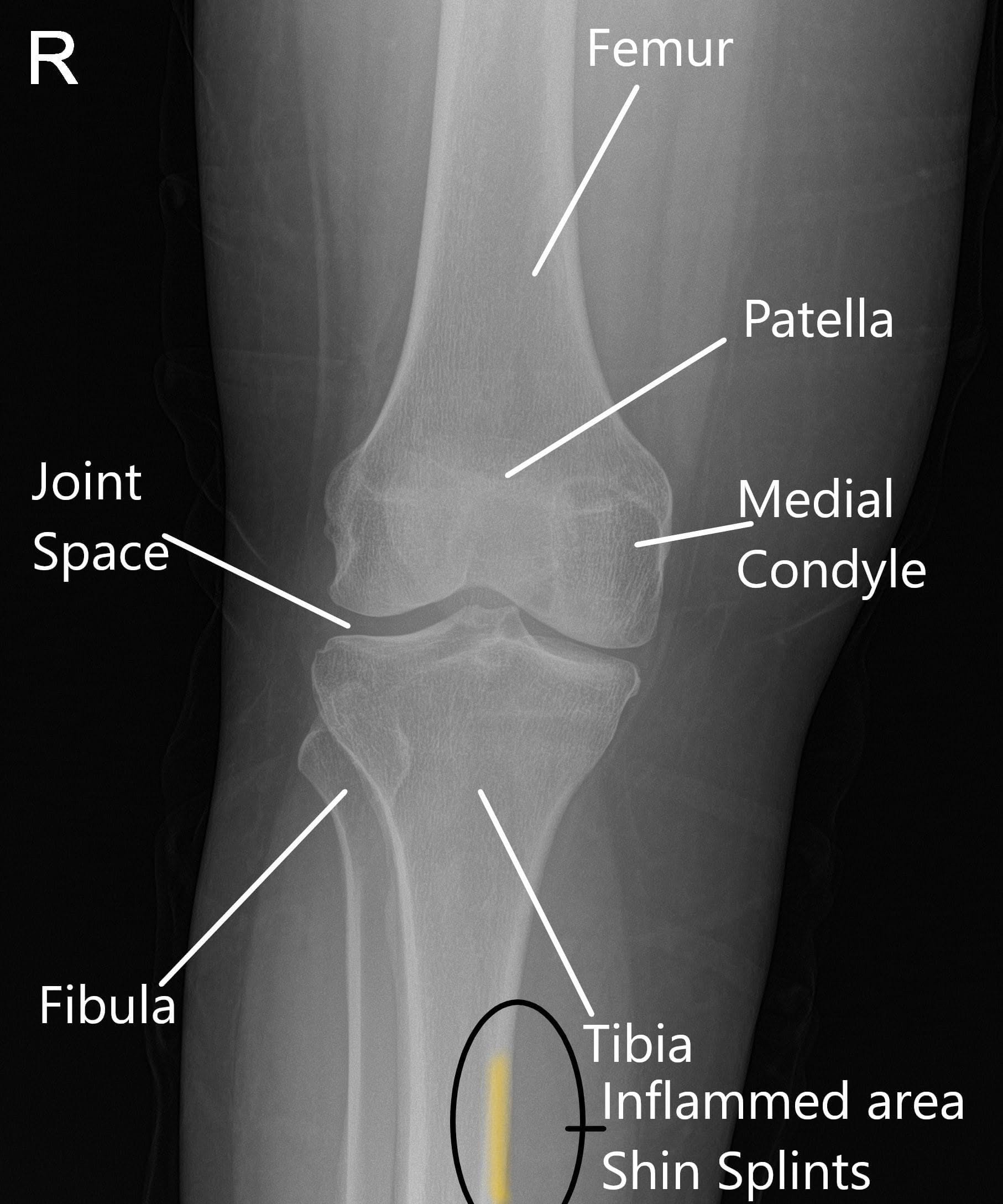 X-ray of a normal knee showing the area of inflammation in shin splints X-ray of a normal knee showing the area of inflammation in shin splints