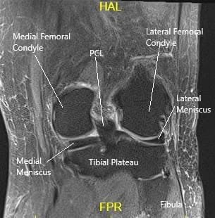 Resonancia magnética de la rodilla en corte coronal mostrando diversas estructuras