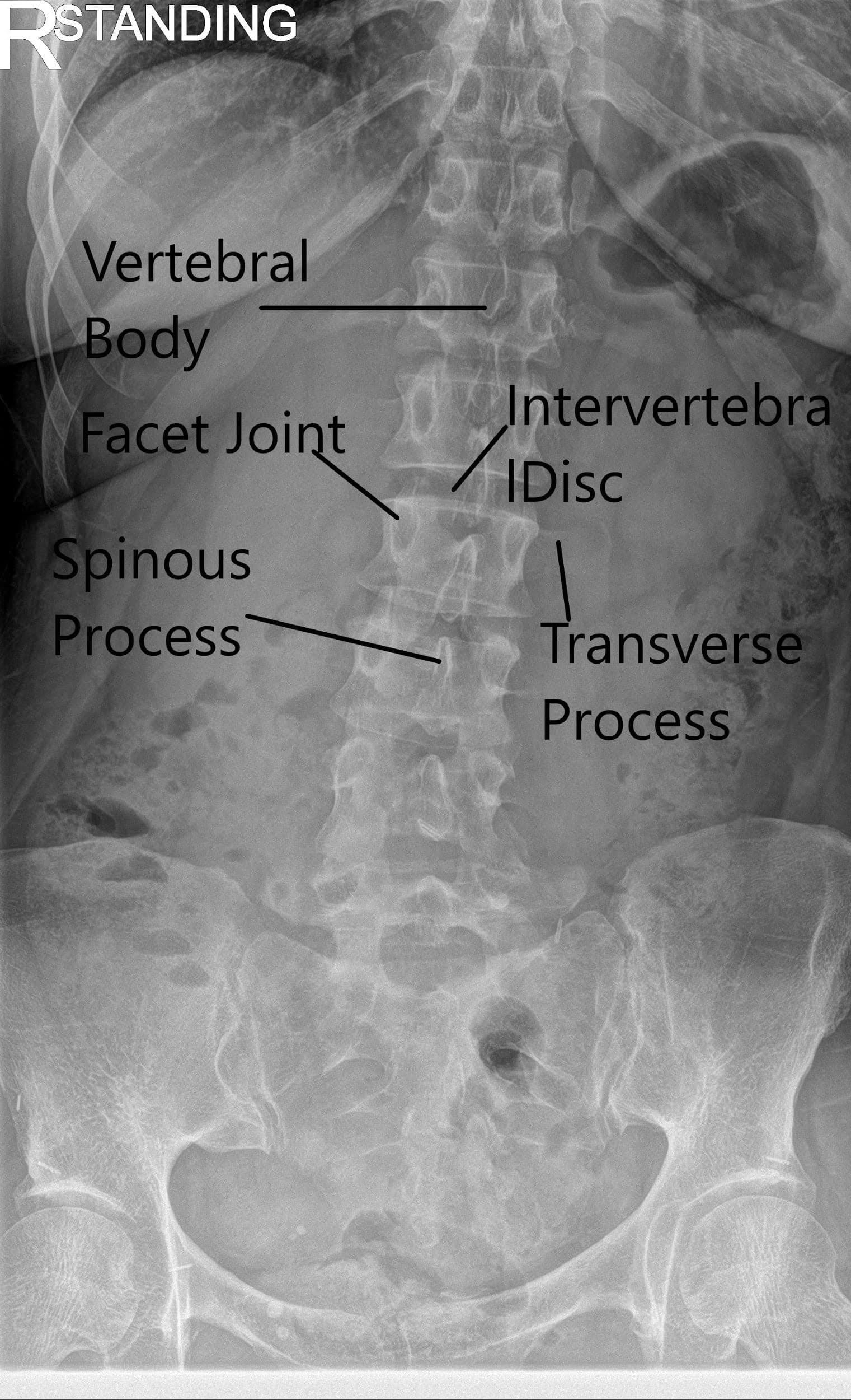 X-ray of the LS spine in AP and Lateral views showing degenerative changes X-ray of the LS spine in AP and Lateral views showing degenerative changes