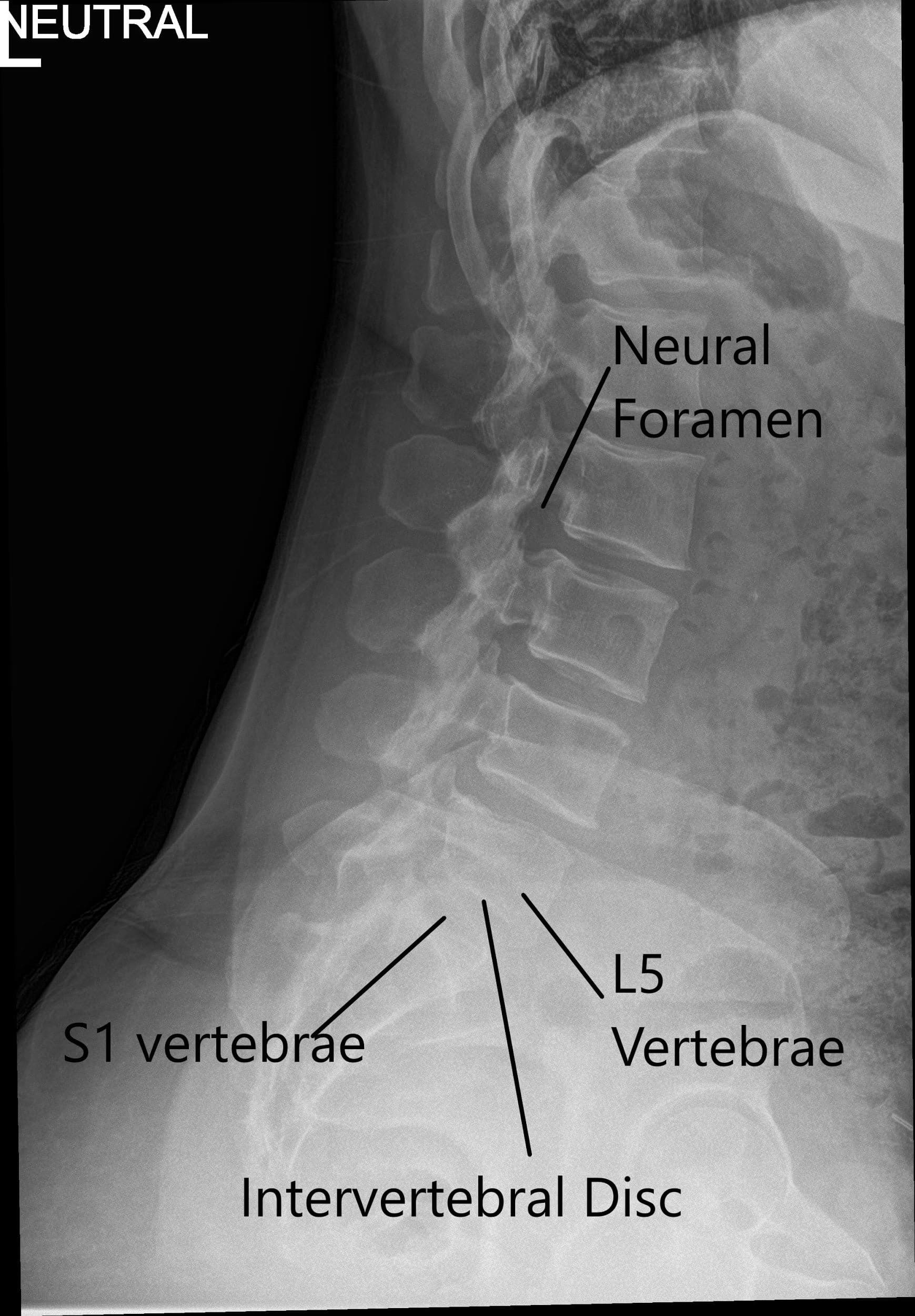 X-ray of the LS spine in AP and Lateral views showing degenerative changes 2 X-ray of the LS spine in AP and Lateral views showing degenerative changes 2
