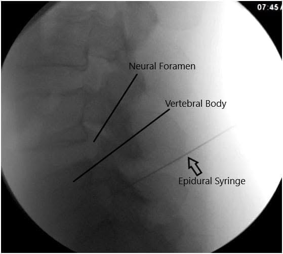 Intraoperative Fluoroscopy Images Intraoperative Fluoroscopy Images