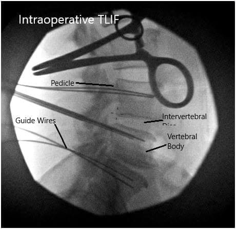 Imágenes fluoroscópicas intraoperatorias Imágenes fluoroscópicas intraoperatorias
