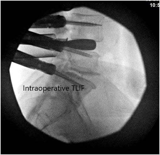 Imágenes fluoroscópicas intraoperatorias 2 Imágenes fluoroscópicas intraoperatorias 2