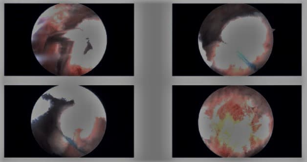 Imágenes artroscópicas intraoperatorias