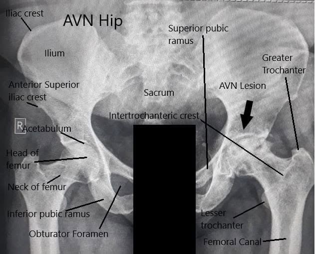 X-ray of both the hip joints showing AVN of the left hip X-ray of both the hip joints showing AVN of the left hip