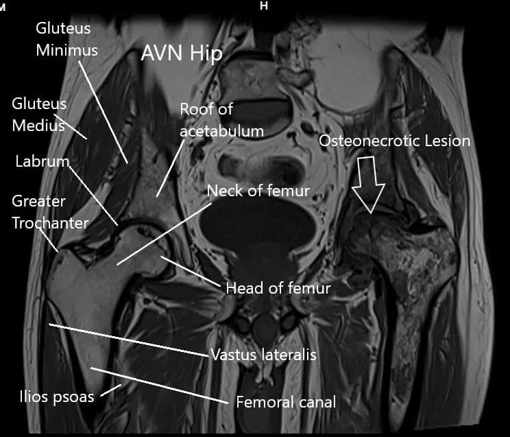 MRI of both the hip joints in the coronal section MRI of both the hip joints in the coronal section