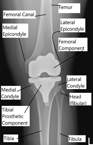 Radiografía de prótesis total de rodilla