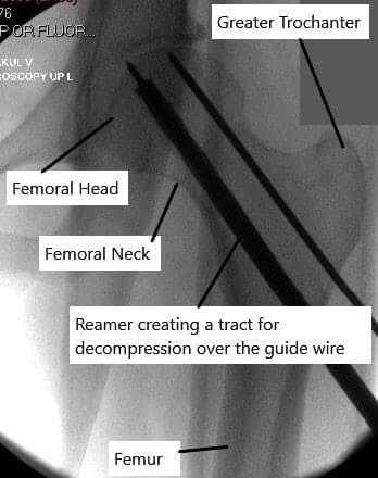 Reaming instrument passed over the guidewire.