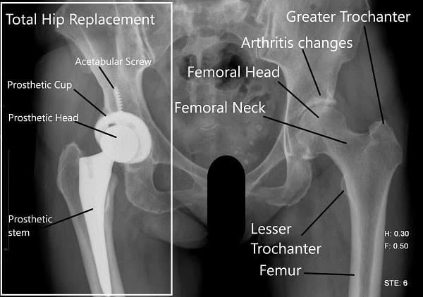 Hip x-ray
