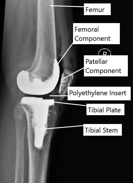 Reemplazo total de rodilla
