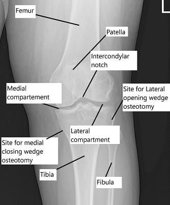 Osteotomía tibial alta