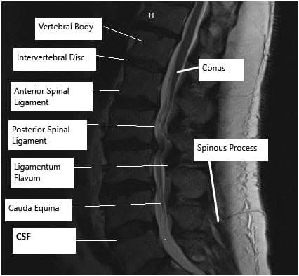 Resonancia magnética de la columna lumbar
