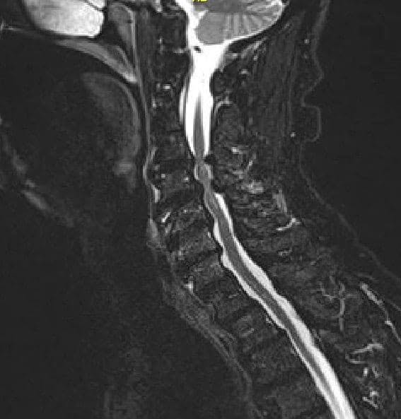 Imagen de la resonancia magnética T2 Corte sagital medio que muestra estenosis y compresión severa de la médula espinal en C3-4 y C 5-6 con enfermedad degenerativa de la articulación cervical