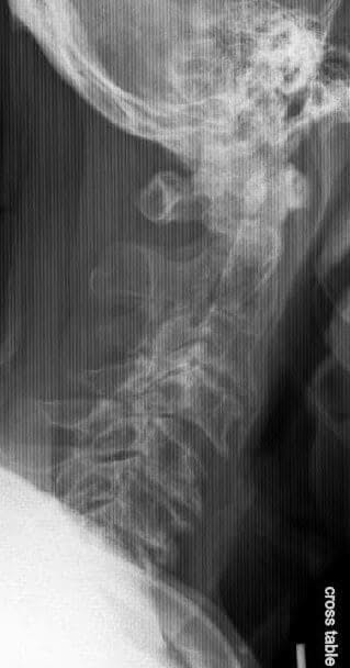 Radiografías Vista lateral de la columna cervical que muestra enfermedad degenerativa avanzada de la columna cervical