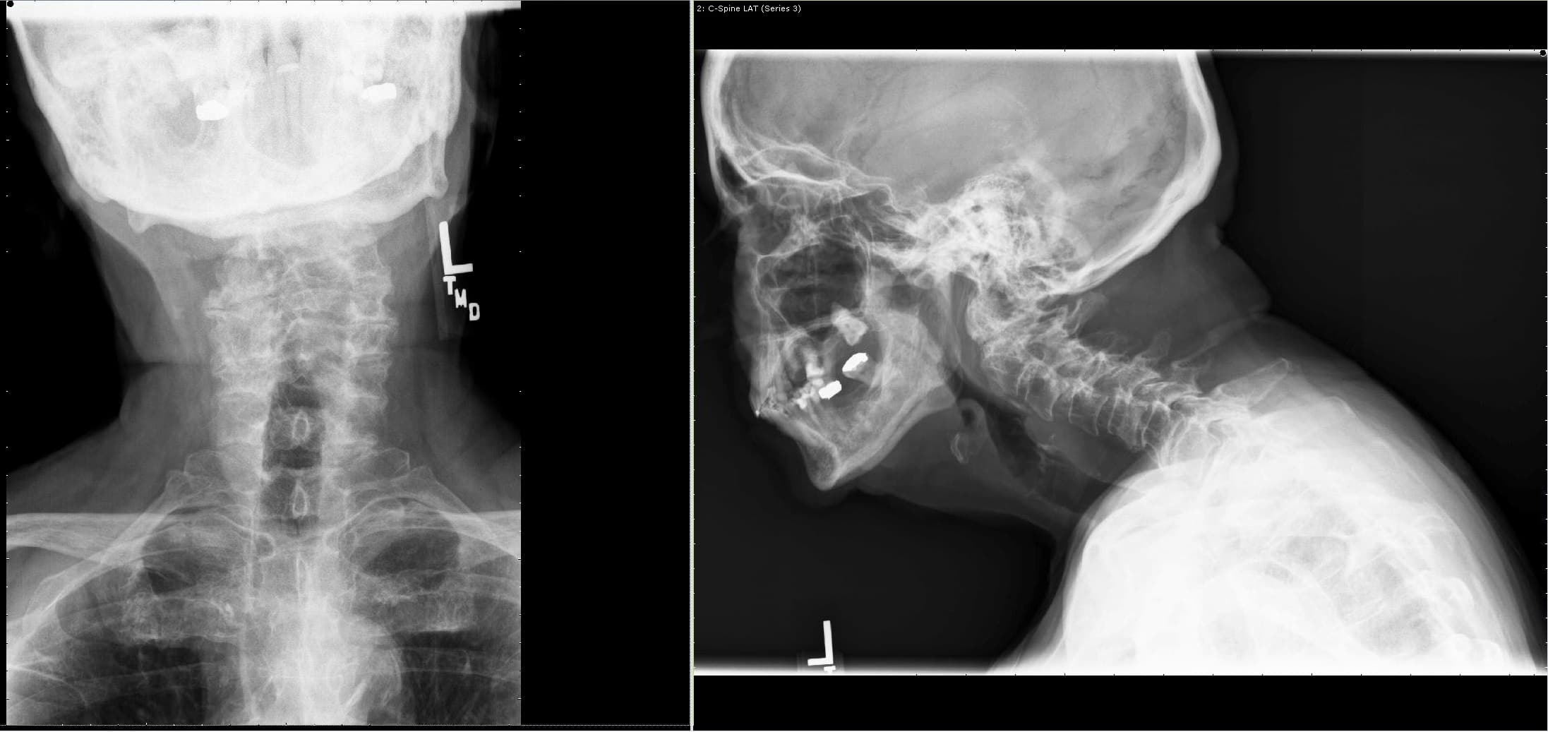 AP and Lateral view of X rays showing a suspected odontoid fracture with instability at C1-2