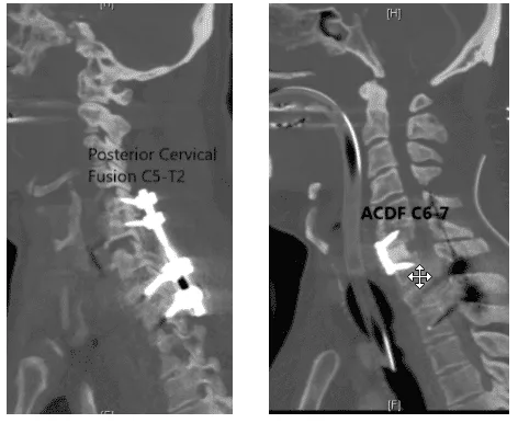 Posterior Spinal Fusion C5-T2