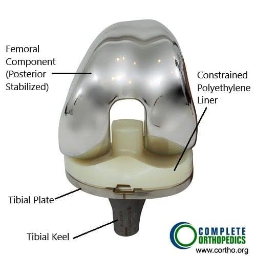 Componentes de la prótesis total de rodilla (vista frontal)