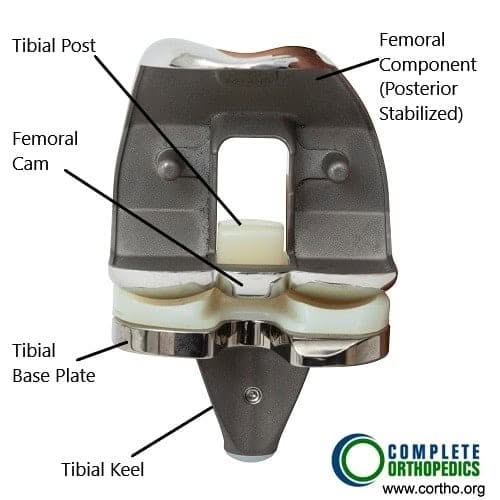 Componentes de la prótesis total de rodilla (vista frontal)