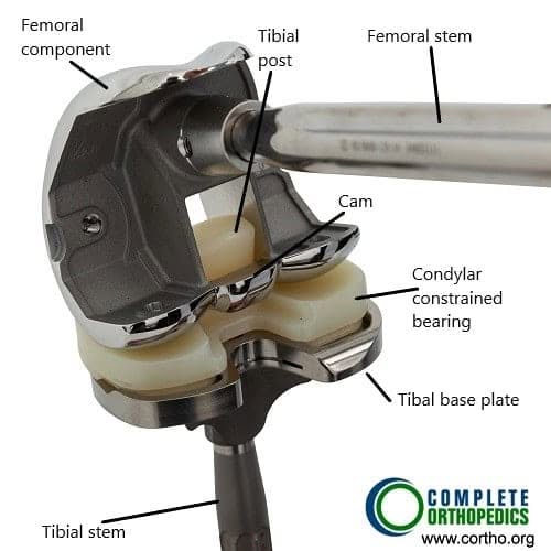 Componentes modulares de rodilla de revisión