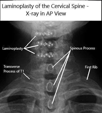 AP and Lateral view X rays of Laminoplasty C3-6