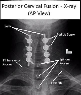 AP and Lateral View X-rays of Posterior Cervical Laminectomy and Fusion AP and Lateral View X-rays of Posterior Cervical Laminectomy and Fusion