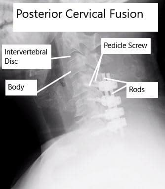 AP and Lateral View X-rays of Posterior Cervical Laminectomy and Fusion AP and Lateral View X-rays of Posterior Cervical Laminectomy and Fusion