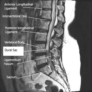 Sección sagital (RM) de la columna lumbar que muestra saco dural.