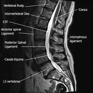 MRI of the lumbar spine showing the interspinous ligament and the spinous process.