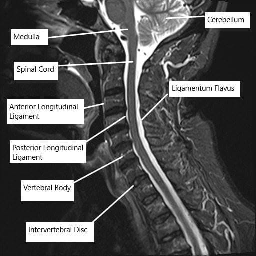 Resonancia magnética de la columna cervical que muestra los distintos ligamentos que rodean la médula espinal.