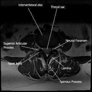MRI axial section showing the facet joint.