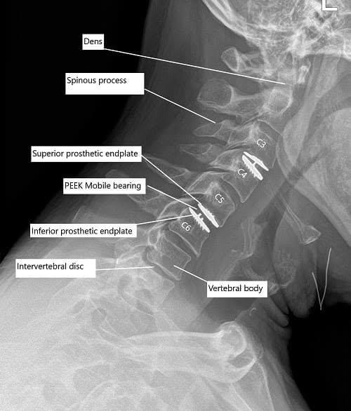 Radiografía postoperatoria de la columna cervical que mostró reemplazo total del disco cervical en C3-C4 y C5-C6.