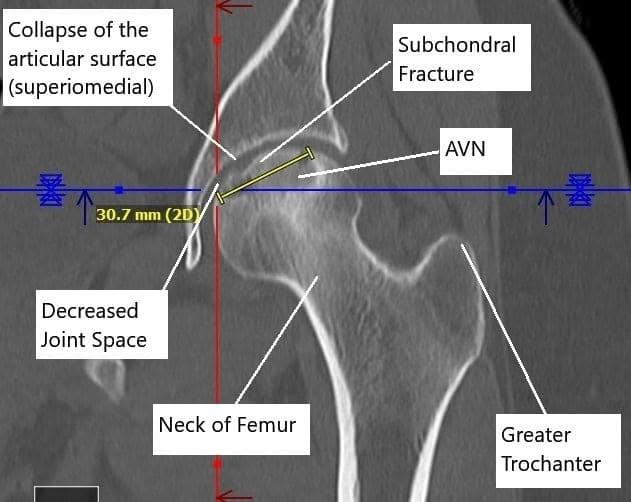 Non-contrast CT image showing AVN changes in the left head of the femur. Non-contrast CT image showing AVN changes in the left head of the femur.