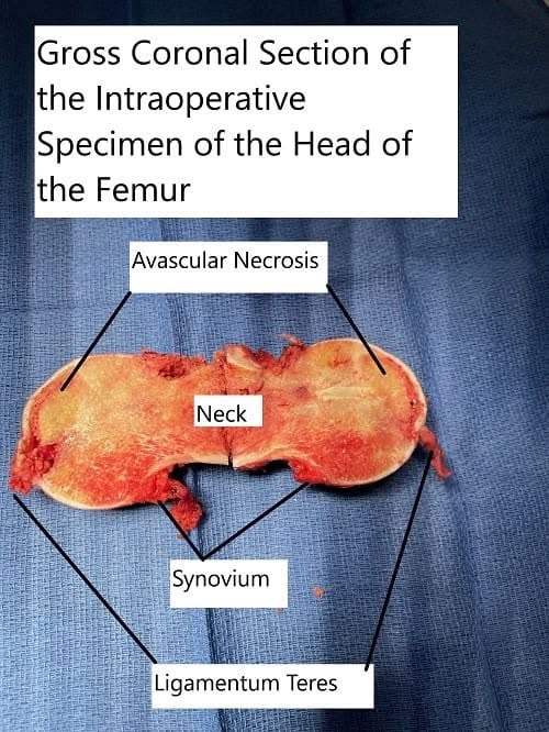 Intraoperative extracted head of the femur with a coronal cut section showing the avascular necrotic area in the superior medial head. Intraoperative extracted head of the femur with a coronal cut section showing the avascular necrotic area in the superior medial head.