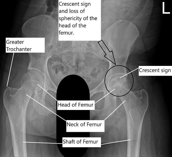 X-ray of the pelvis with both hip joints showing AVN of the left head of the femur. X-ray of the pelvis with both hip joints showing AVN of the left head of the femur.
