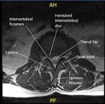 Sección de resonancia axial preoperatoria a nivel L2-L3 que muestra hernia de disco.