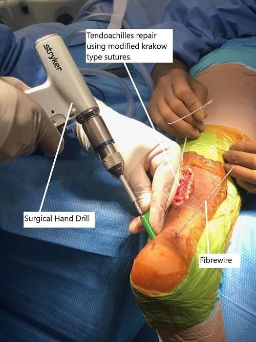 Imagen intraoperatoria que muestra la reparación del tendón de Aquiles.
