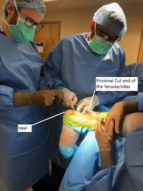 Imagen intraoperatoria de la reparación del tendoaquiles.