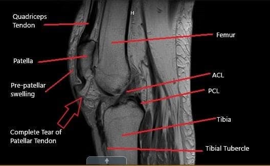 MRI of the knee in the sagittal section showing a complete tear of the patellar tendon.