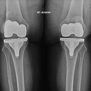 Radiografía-de-reemplazo-articular