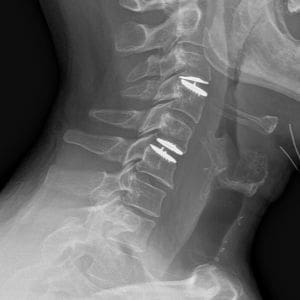 spine xray
