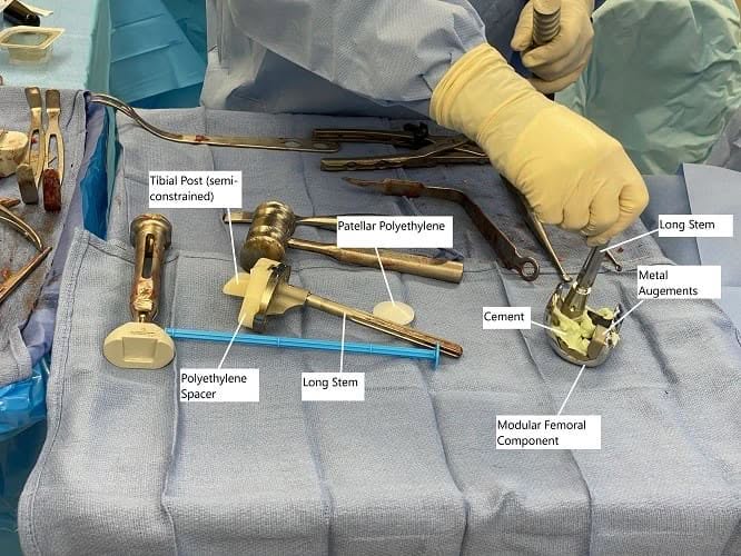 Imagen intraoperatoria que muestra implantes modulares de reemplazo de rodilla.