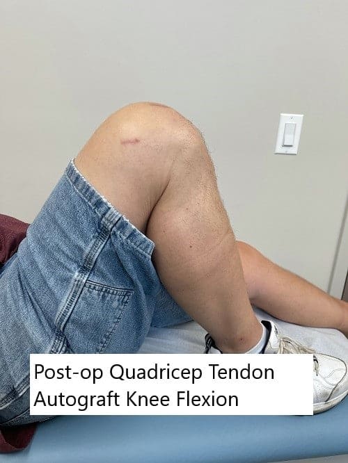 Imágenes postoperatorias que muestran la cicatriz del autoinjerto del tendón del cuádriceps y la amplitud de movimiento.