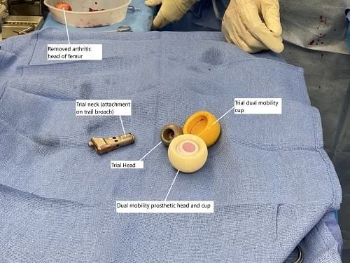 Imagen intraoperatoria que muestra un sistema de copa de doble movilidad utilizado para mayor estabilidad y prevención de dislocaciones.